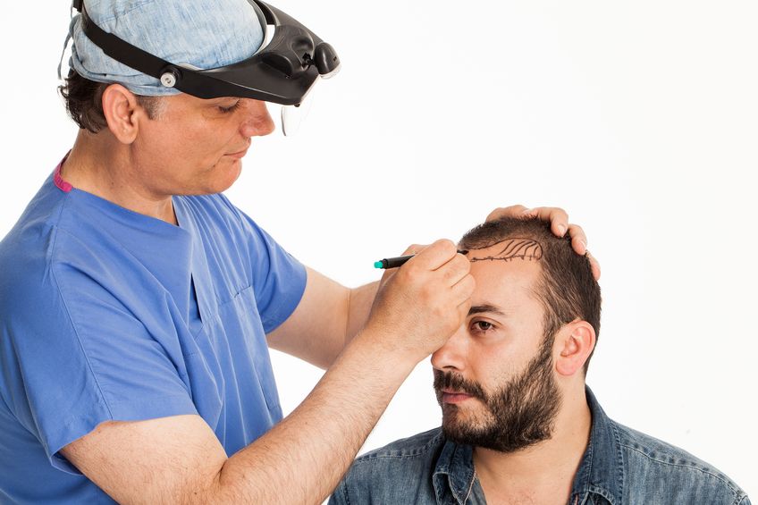 Trapianto di capelli Fue - Rimozione follicolare per unitá